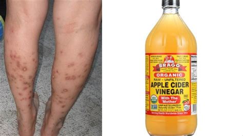 Get Rid Of Dark Spots With Apple Cider Vinegar Apple Poster