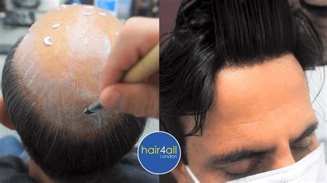 Super Close Up Hair System Before And After Non Surgical Hair Replacement System Men Women Uk