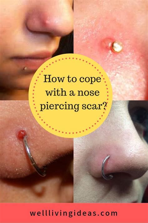 How To Get Rid Of A Nose Piercing Bump Fast Keloid The Best Effective Treatme Bump