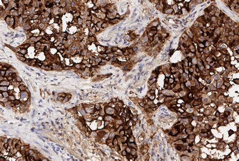 Single Cell Map Of Early Stage Lung Cancer And Normal Lung Sheds Light