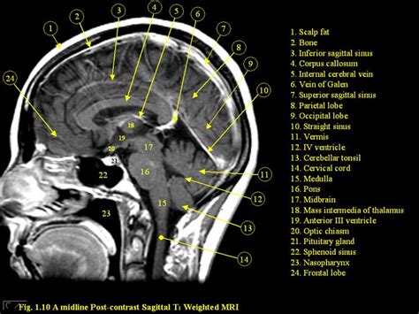 Brain Mri Labeled