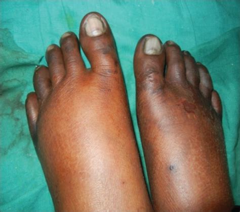 Blackening Of Skin Of All The Toes On Both Feet With Swelling