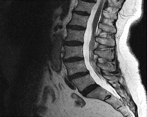 Healthcare Extreme How To Read An Mri Lumbar Spine In Easy Steps