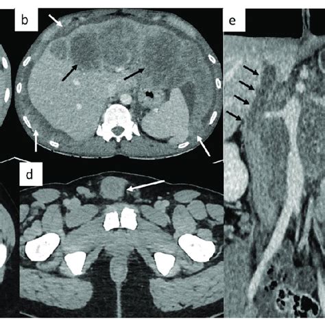 Small Disease Thoracic Ct Reveals A Small Left Supraclavicular Lymph