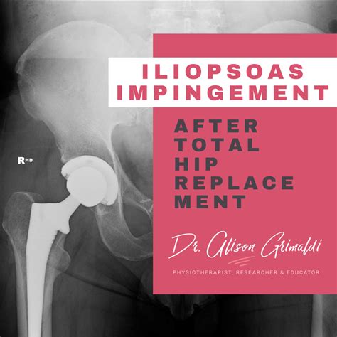 The Dangers Of A Loose Hip Replacement Brandon Orthopedics