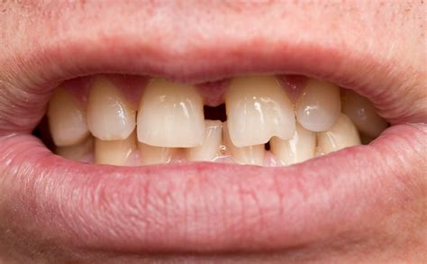 How To Fix Teeth Misalignment Grow Health Vending