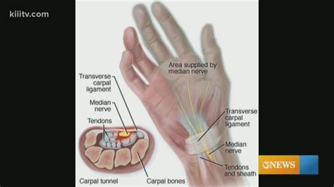 Most of the time there is no one cause that can be found for carpal tunnel syndrome, and often there are multiple risk factors that may be contributing. The Dr. Is In - Carpal Tunnel Syndrome | kiiitv.com