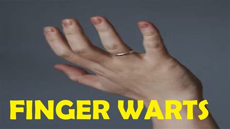 How To Get Rid Of Finger Warts Quickly Youtube