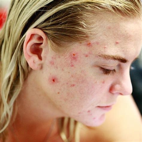 Best Ways To Fade Acne Scars