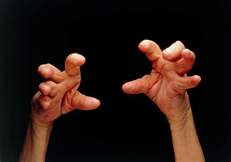Hands Affected By Rheumatoid Arthritis Photograph By Medical Photo Nhs