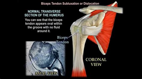 Biceps Tendon Subluxation Or Dislocation Orthopaedicprinciples