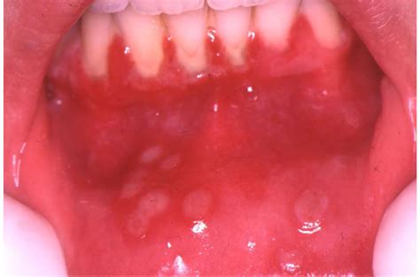 The herpes simplex virus (hsv) is a member of the herpesviridae family, of which two types are known: Herpes Simplex Virus (Hsv) Infection Of The Mouth - European Association of Oral Medicine
