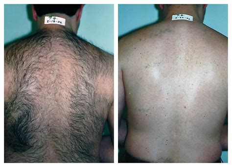 Laser Hair Removal For Men In Pittsburgh Happel Laser Spa