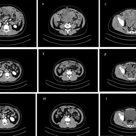 Abdominal Ct Showing The Radiological Response To Combined And