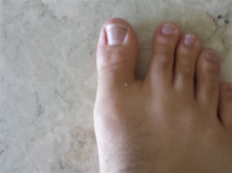 What Can I Do For Gout In My Foot
