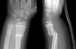 Clinical Practice Guidelines Metaphyseal Fractures Of The Distal Radius And Or Ulna