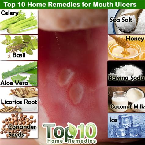 Home Remedies For Mouth Ulcers Top 10 Home Remedies