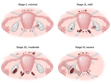 However, this does not explain other cancer risk among women with endometriosis. Patient Information - Brisbane Centre for Endometriosis