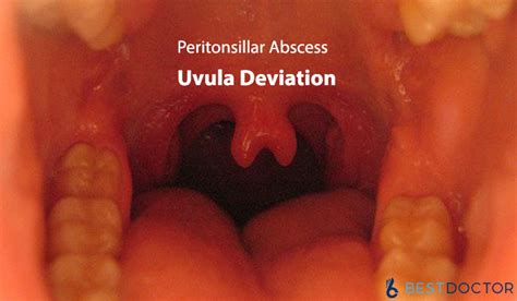 Uvula Deviation Causes And Symptoms Best Doctor