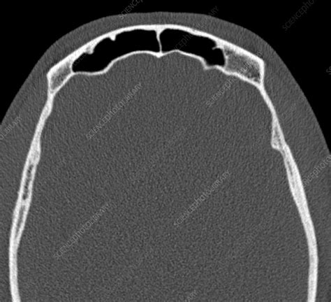 Normal Frontal Sinus Ct Scan Stock Image C0292402 Science Photo