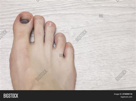 Injury Nail On Foot Image And Photo Free Trial Bigstock
