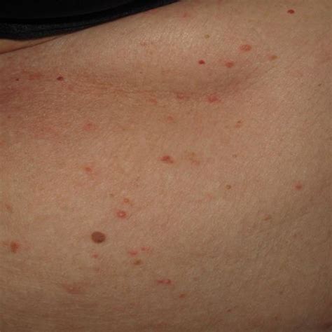 Papulo Vesicular Rash Disseminated On The Patients Trunk Download