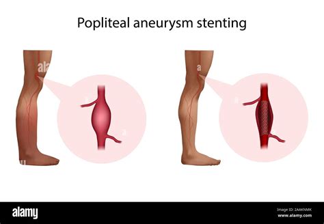 Poplitea Aneurysma Stenting Abbildung Vor Und Nach Der Operation