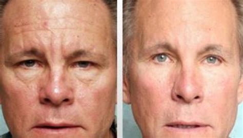 Dermaroller Before And After Wrinkles Home Treatment Rejuviss