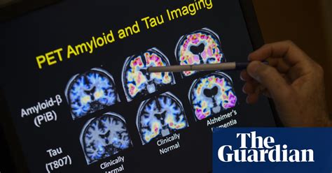 Research Shines Light On Why Women More Likely To Develop Alzheimers Society The Guardian