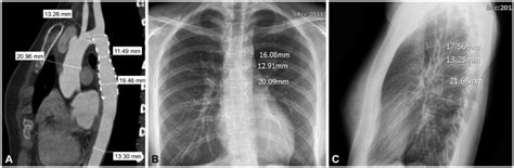 Images Of The Aortic Coarctation 3 Months After The Insertion Of The