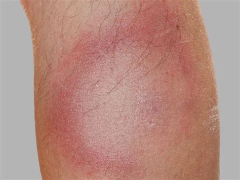 Lyme Disease Rash Symptoms Stages And Identification Lyme Disease