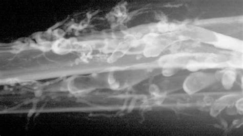 Es gibt verschiedene ursachen, die zu einer thrombose führen können. Thrombose - babywelten.ch