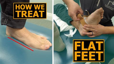 How We Treat Flat Feet Collapsed Arches Physical Therapy Youtube