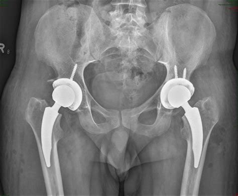 Hip And Groin Surgery Hip Replacement And More Trambellir