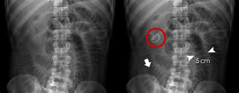 Abdominal X Ray Abnormal Bowel Gas Pattern Small Bowel Obstruction