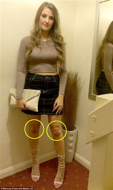 بالصور فتاة تدعي أن ركبتيها تشبهان رئيس كوريا وممثلا بريطانيا المدينة نيوز