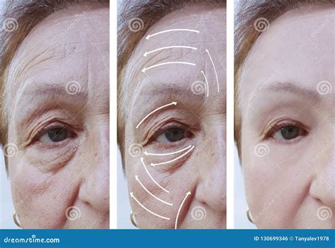 Woman Elderly Face Skin Wrinkles Rejuvenation Contrast Before And After