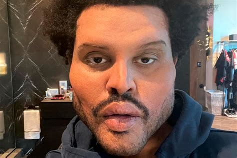Певец The Weeknd показал ужаснувшие фанатов последствия пластической