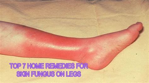 Top 7 Home Remedies For Skin Fungus On Legs Youtube