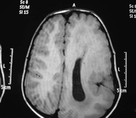Magnetic Resonance Imaging Brain T1‑weighted Axial Image Showing