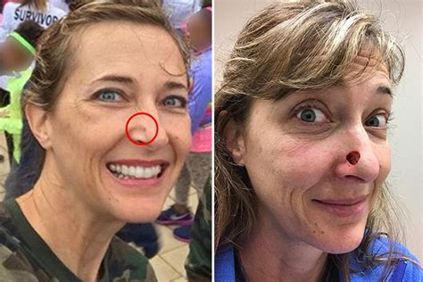 Sun Addict Left With Gaping Hole In Her Nose After Pimple Turns Out