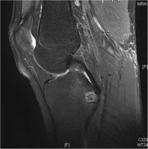 Magnetic Resonance Imaging Scan Of The Left Knee Sagittal View Download Scientific Diagram