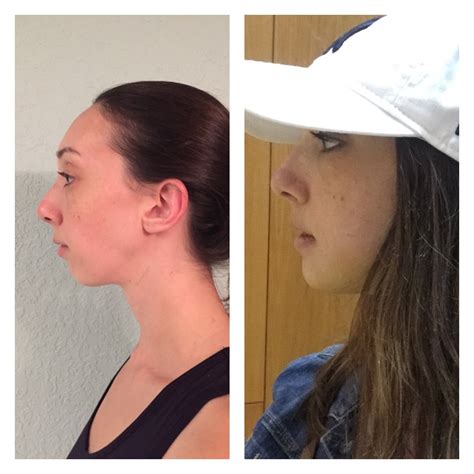My Journey Through Jaw Surgery Four Weeks Post Op Bsso And Genioplasty