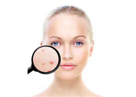 Acne Treatment - Facials & Peels in Harborne, Birmingham