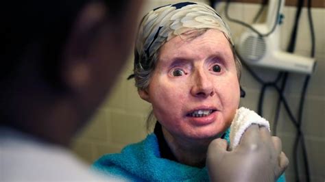 face transplant of charla nash chimp attack victim not in jeopardy doctors cbc news