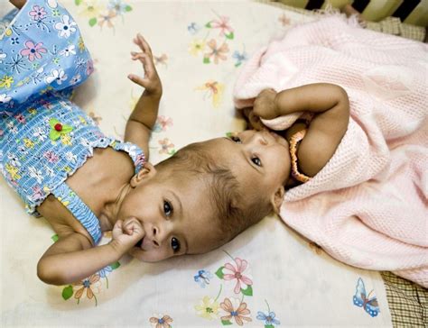 Conjoined Mcdonald Twins Update Separated Twins Move To Rehab As Next