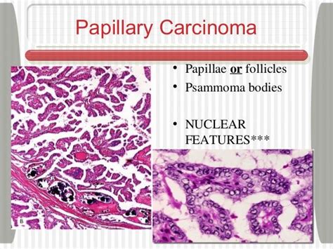 In fact, you can think of papillary thyroid carcinoma as the little orphan annie tumor because Papillary Carcinoma Nuclear Features Optically clear ...