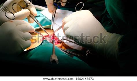Surgeon Performing Inguinal Hernia Repair Hernioplasty Stock Photo