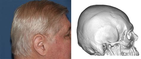 Plastic Surgery Case Study Older Male Skull Augmentation With Two