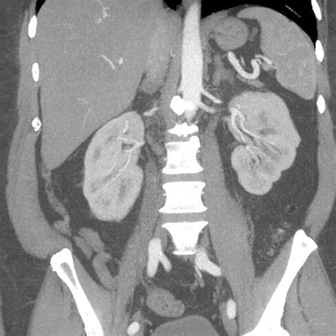 Normal Appendix CT Coronal Of